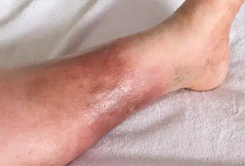 جلطة في الساق اليمنى تظهر تورما واحمرارا شديدين.